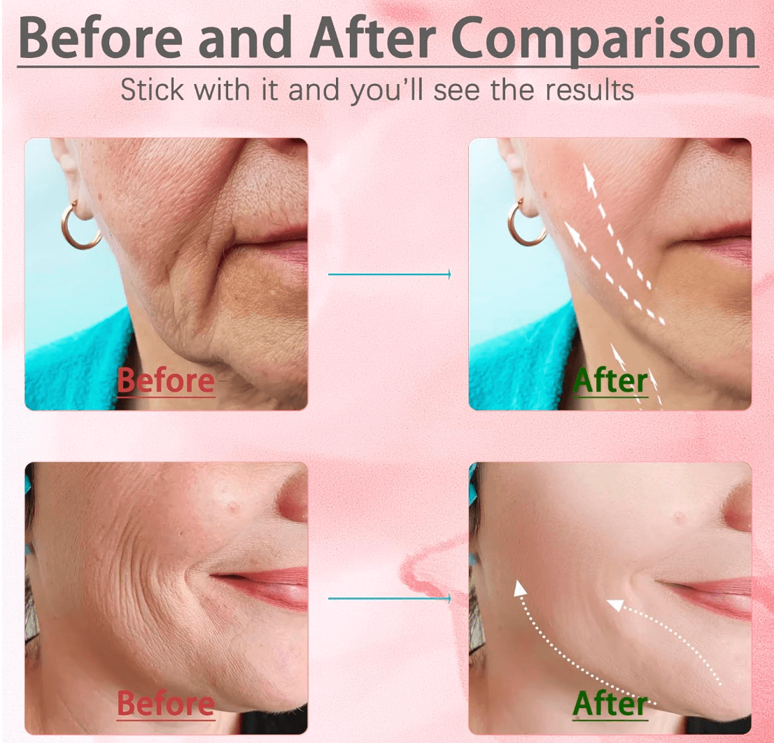 Facial Lifting Device