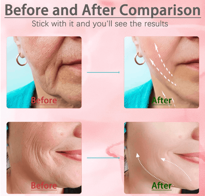 Facial Lifting Device