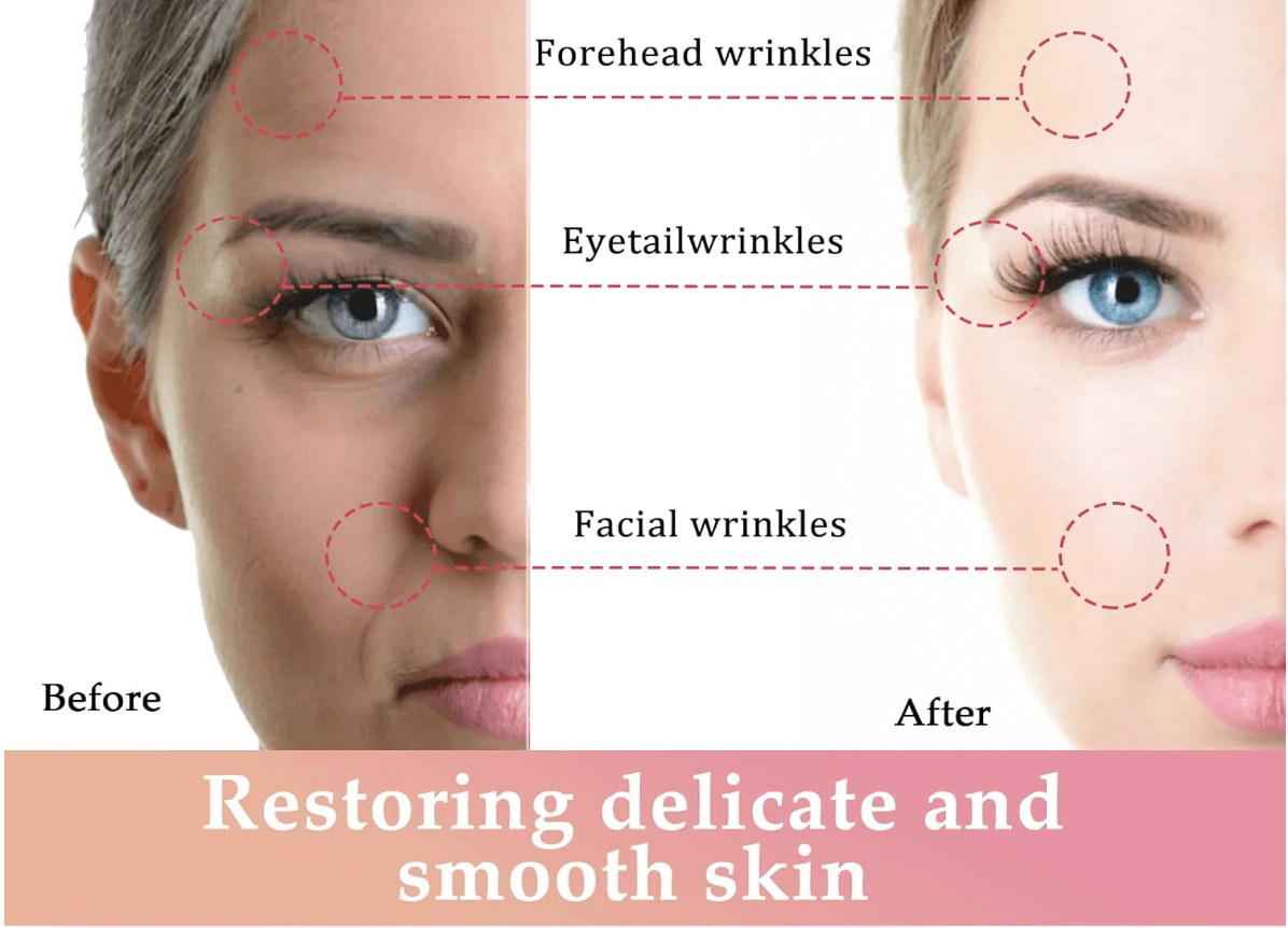 Facial Lifting Device