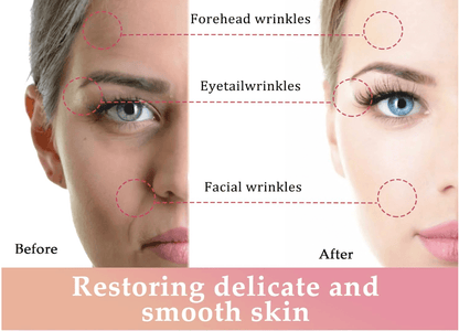 Facial Lifting Device